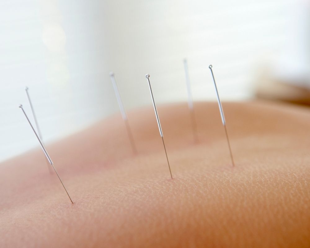 Acupuntura para Dor nas Costas
